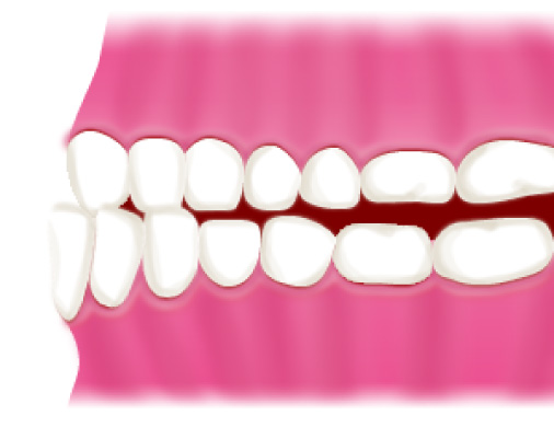 下顎前突症（受け口）